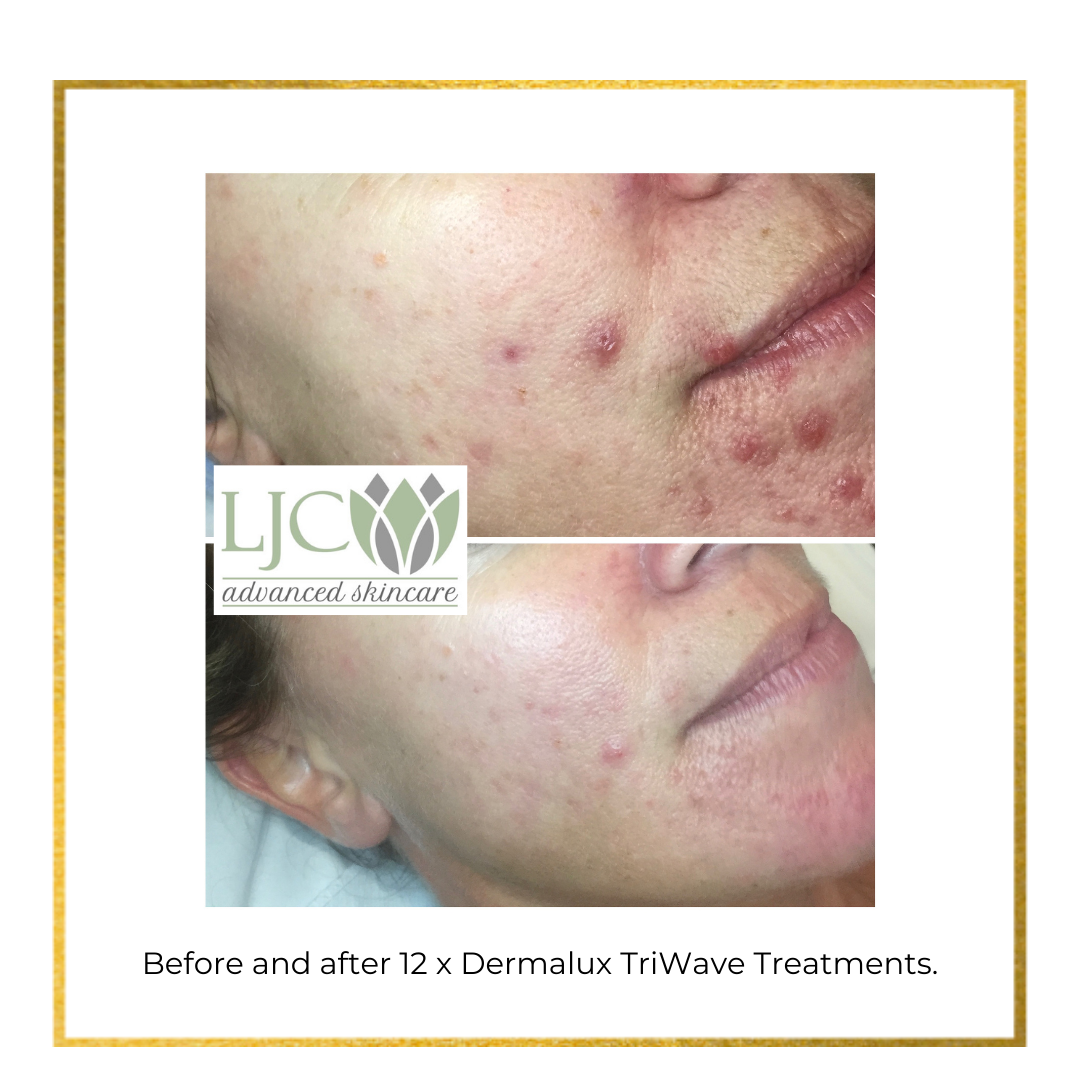 Before and after a course of TriWave Dermalux treatments.