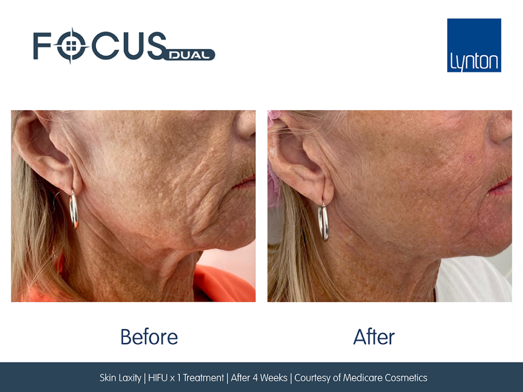 Focus Dual HIFU facial treatment