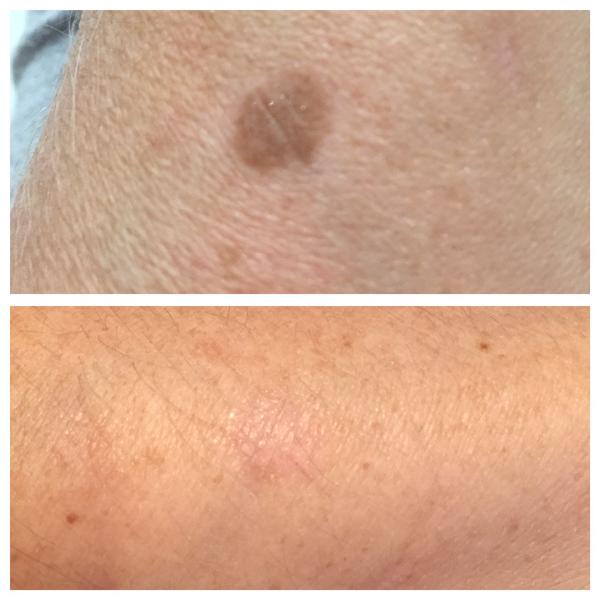 eDermastamp Broadstairs