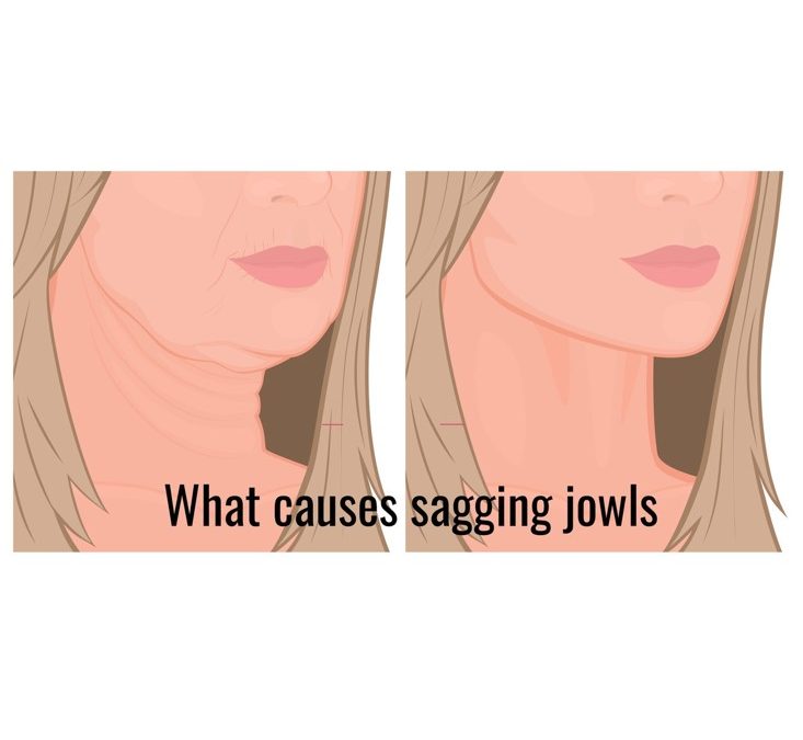 What is the best treatment for sagging jowls? LJC Advanced Skincare