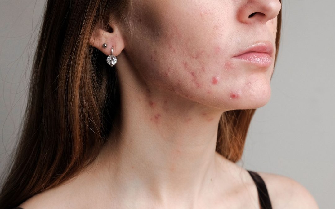 Top Treatments and Tips for Acne-Prone Skin