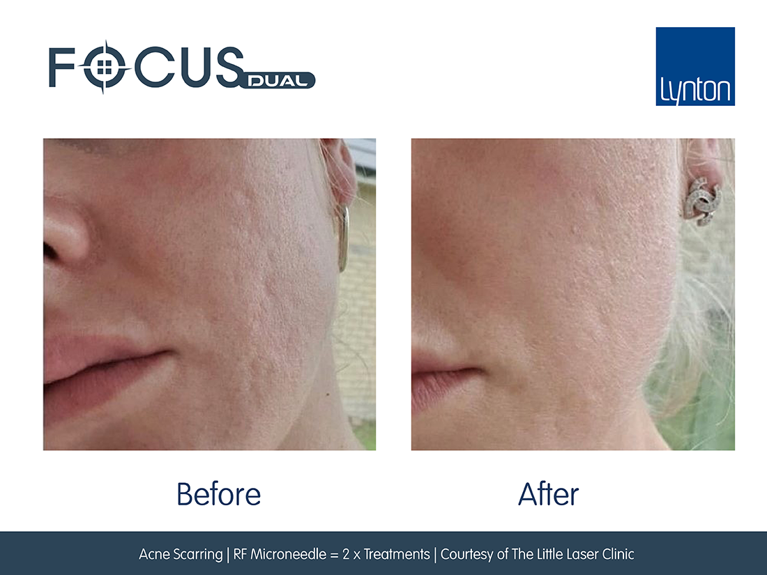 Focus Dual RF Micro-needling for acne scarring