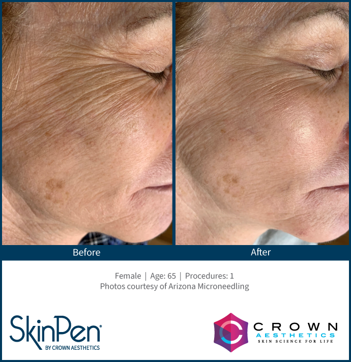 BA-SkinPen-FLAW-KH-Face-ArizonaMicroneedling-1treatment-65YO eDermastamp Broadstairs